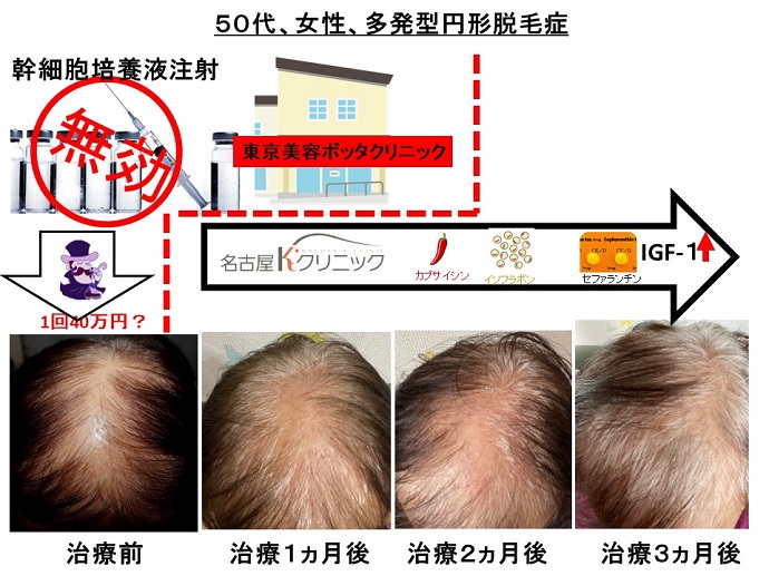 円形脱毛症　病院